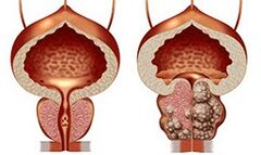 Healthy and unhealthy prostate